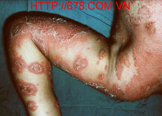 Eczema impetigo hoá